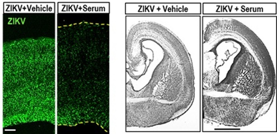 Convalescent Serum Prevents Zika Infection and Microcephaly in Mice