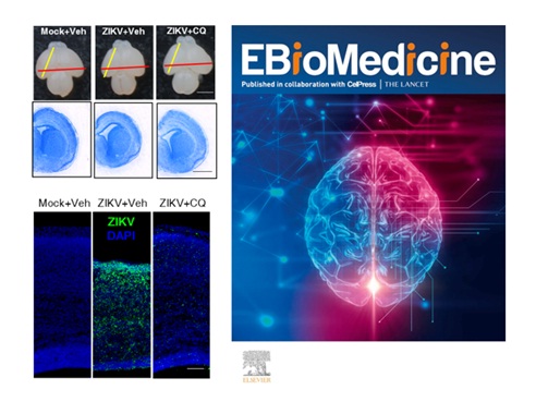 Chloroquine Prevents ZIKV Infection and Its Associated Congenital Microcephaly in Mice