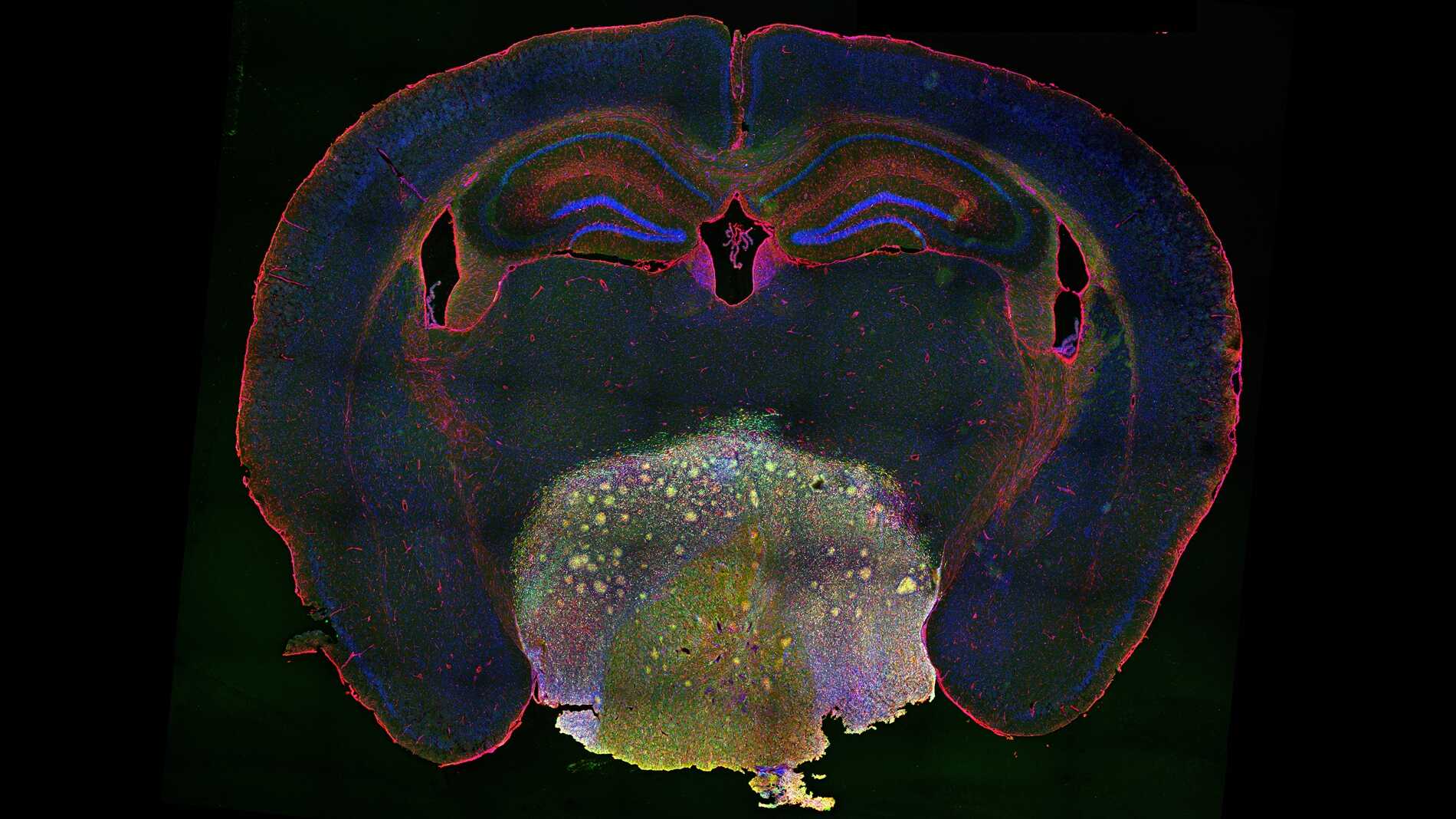 Researchers Unlock Craniopharyngioma Growth Mechanism and Identify Potential New Therapy